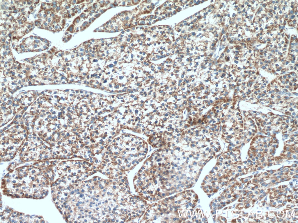 Immunohistochemistry (IHC) staining of human liver cancer tissue using MLKL Polyclonal antibody (21066-1-AP)