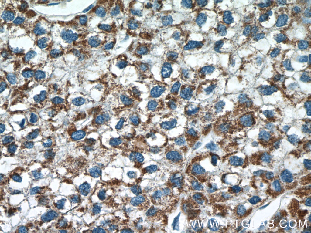 Immunohistochemistry (IHC) staining of human liver cancer tissue using MLKL Polyclonal antibody (21066-1-AP)