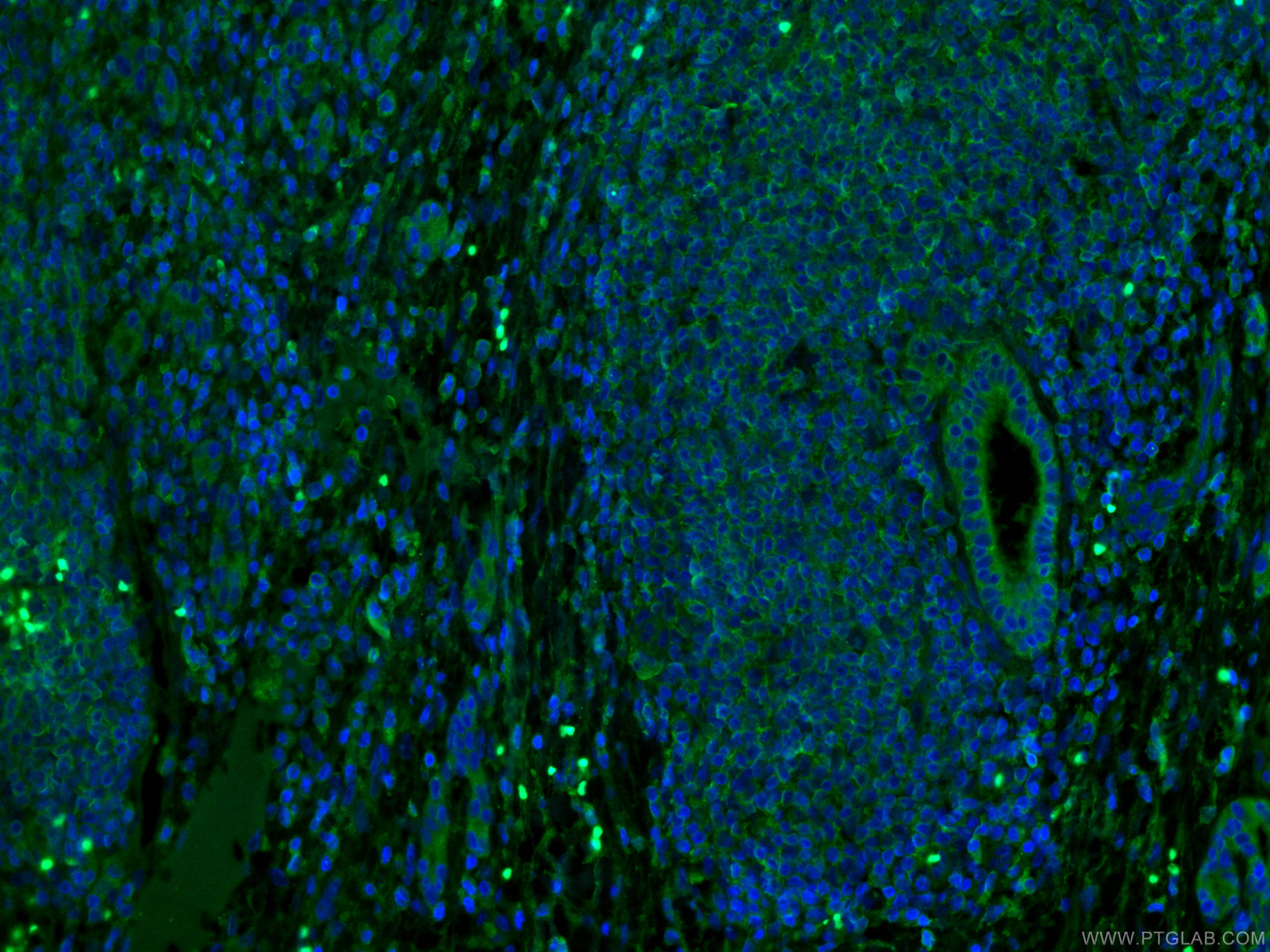 Immunofluorescence (IF) / fluorescent staining of human liver cancer tissue using MLKL Monoclonal antibody (66675-1-Ig)