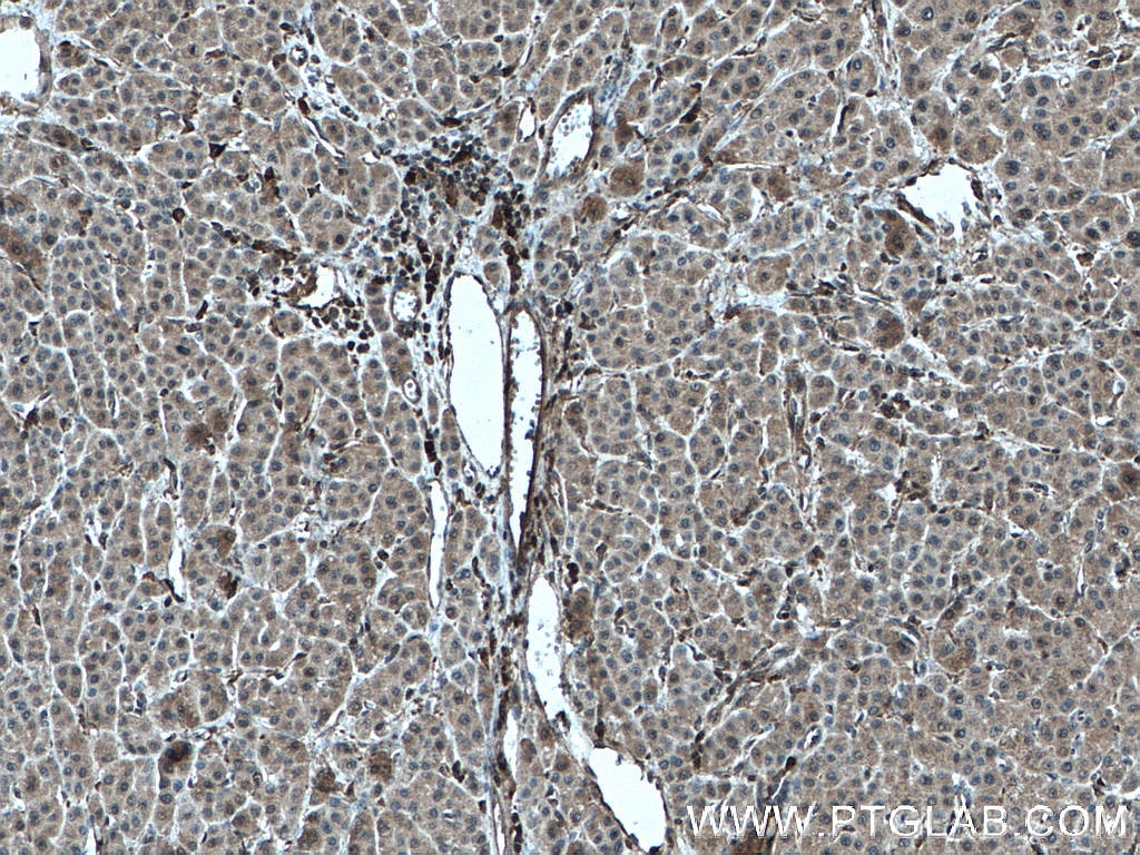 Immunohistochemistry (IHC) staining of human liver cancer tissue using MLKL Monoclonal antibody (66675-1-Ig)
