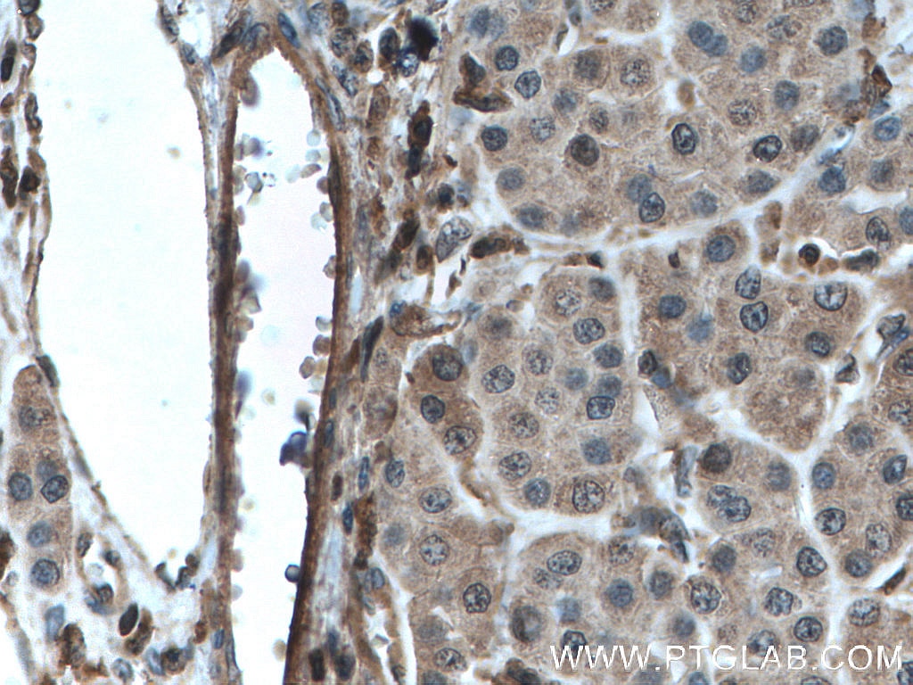 Immunohistochemistry (IHC) staining of human liver cancer tissue using MLKL Monoclonal antibody (66675-1-Ig)