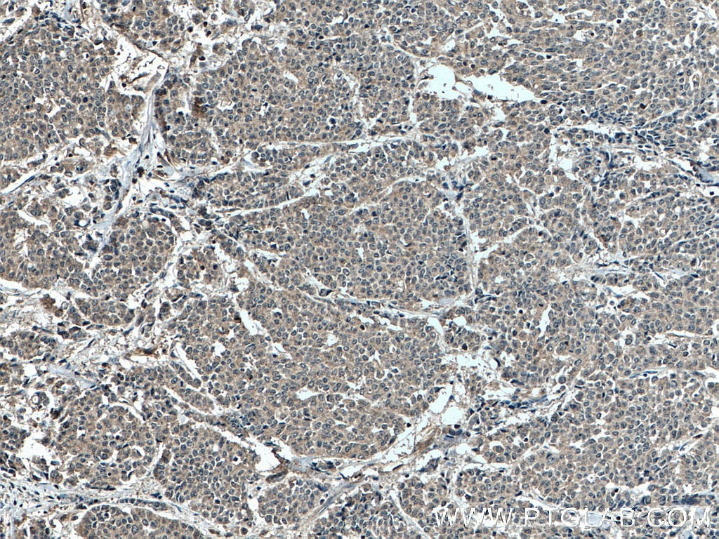 IHC staining of human colon cancer using 66675-1-Ig