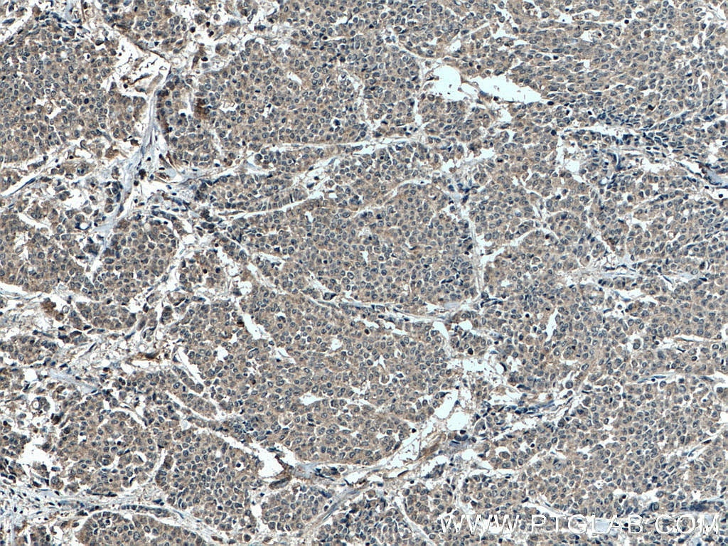 Immunohistochemistry (IHC) staining of human colon cancer tissue using MLKL Monoclonal antibody (66675-1-Ig)