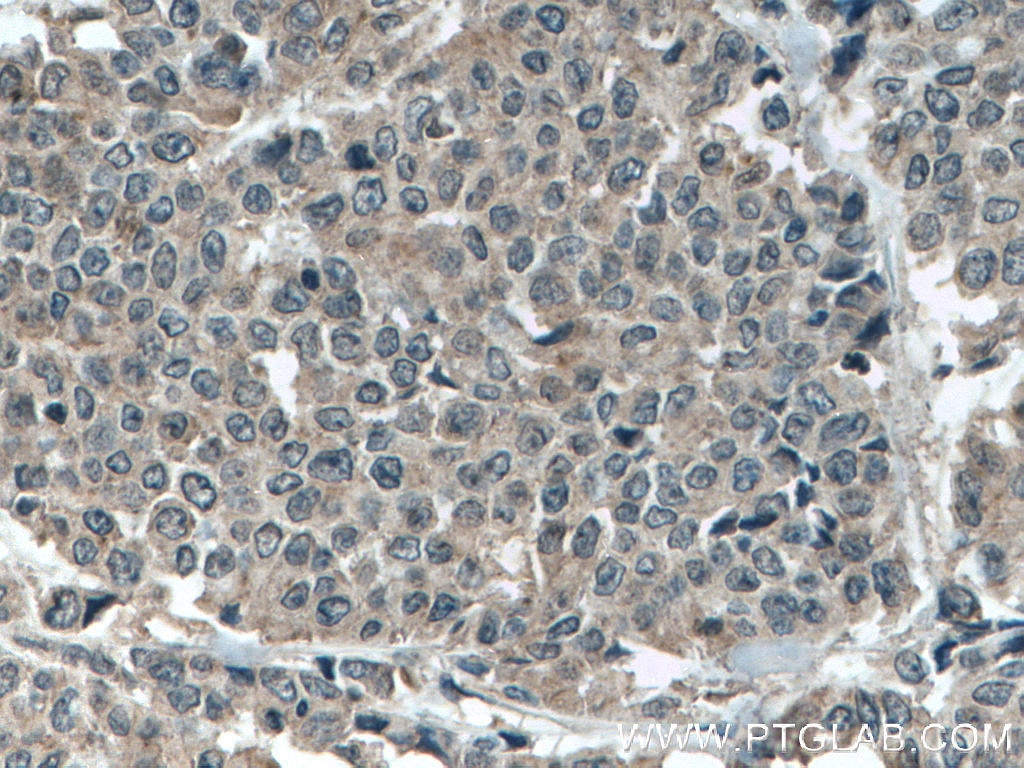 Immunohistochemistry (IHC) staining of human colon cancer tissue using MLKL Monoclonal antibody (66675-1-Ig)
