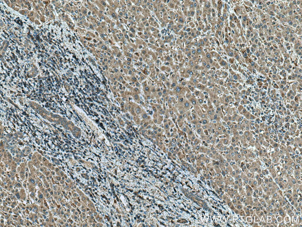 IHC staining of human liver cancer using 66675-1-Ig