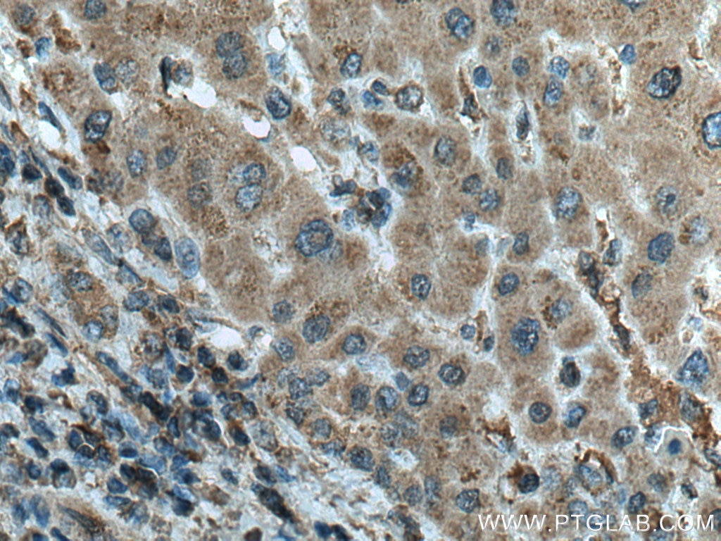 IHC staining of human liver cancer using 66675-1-Ig