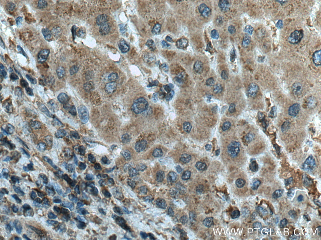 Immunohistochemistry (IHC) staining of human liver cancer tissue using MLKL Monoclonal antibody (66675-1-Ig)