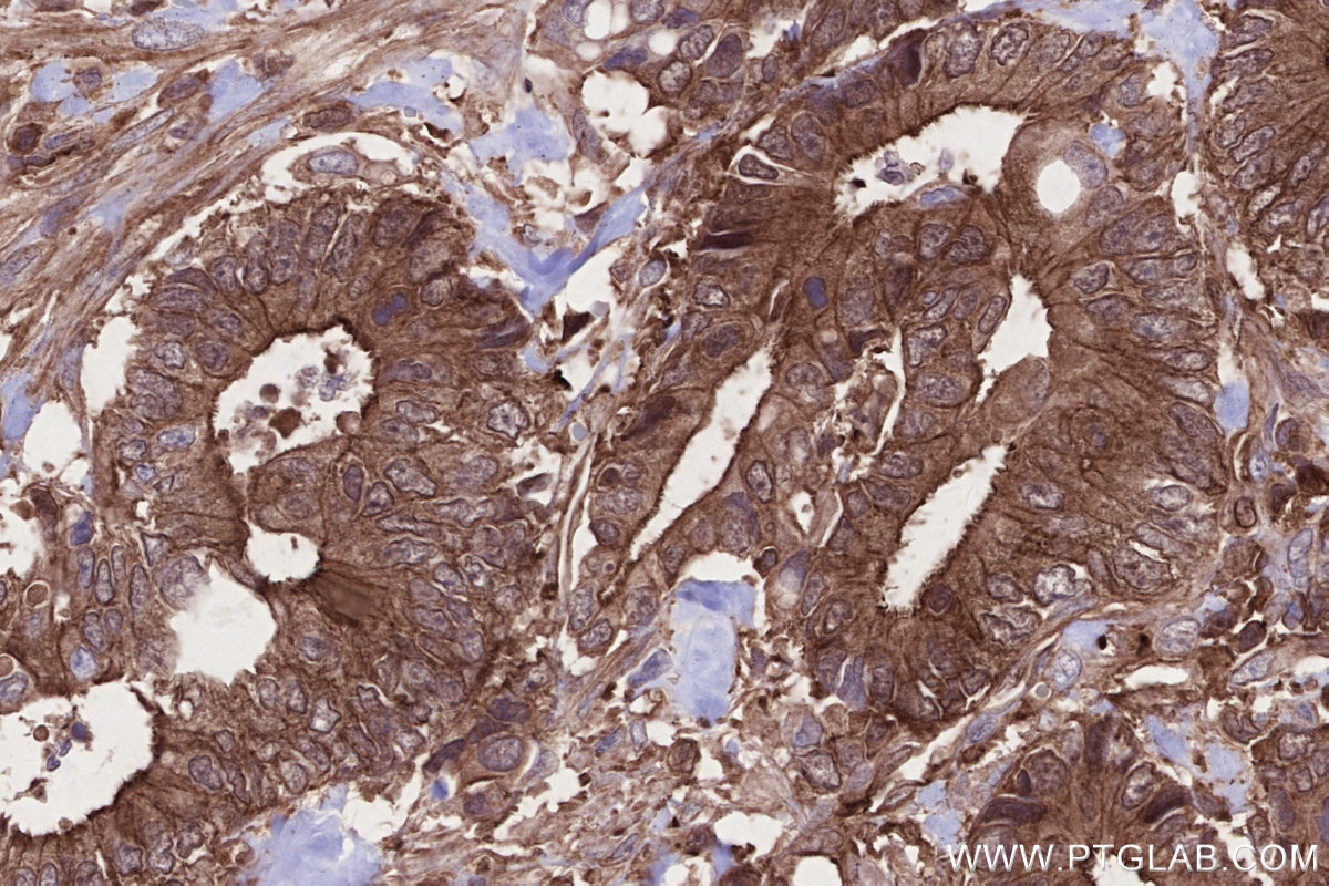 IHC staining of human rectal cancer using 66675-1-Ig Immunohistochemistry (IHC) staining of human rectal cancer tissue using MLKL Monoclonal antibody (66675-1-Ig)