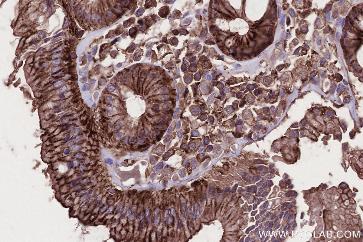 IHC staining of human rectal cancer using 66675-1-Ig Immunohistochemistry (IHC) staining of human rectal cancer tissue using MLKL Monoclonal antibody (66675-1-Ig)