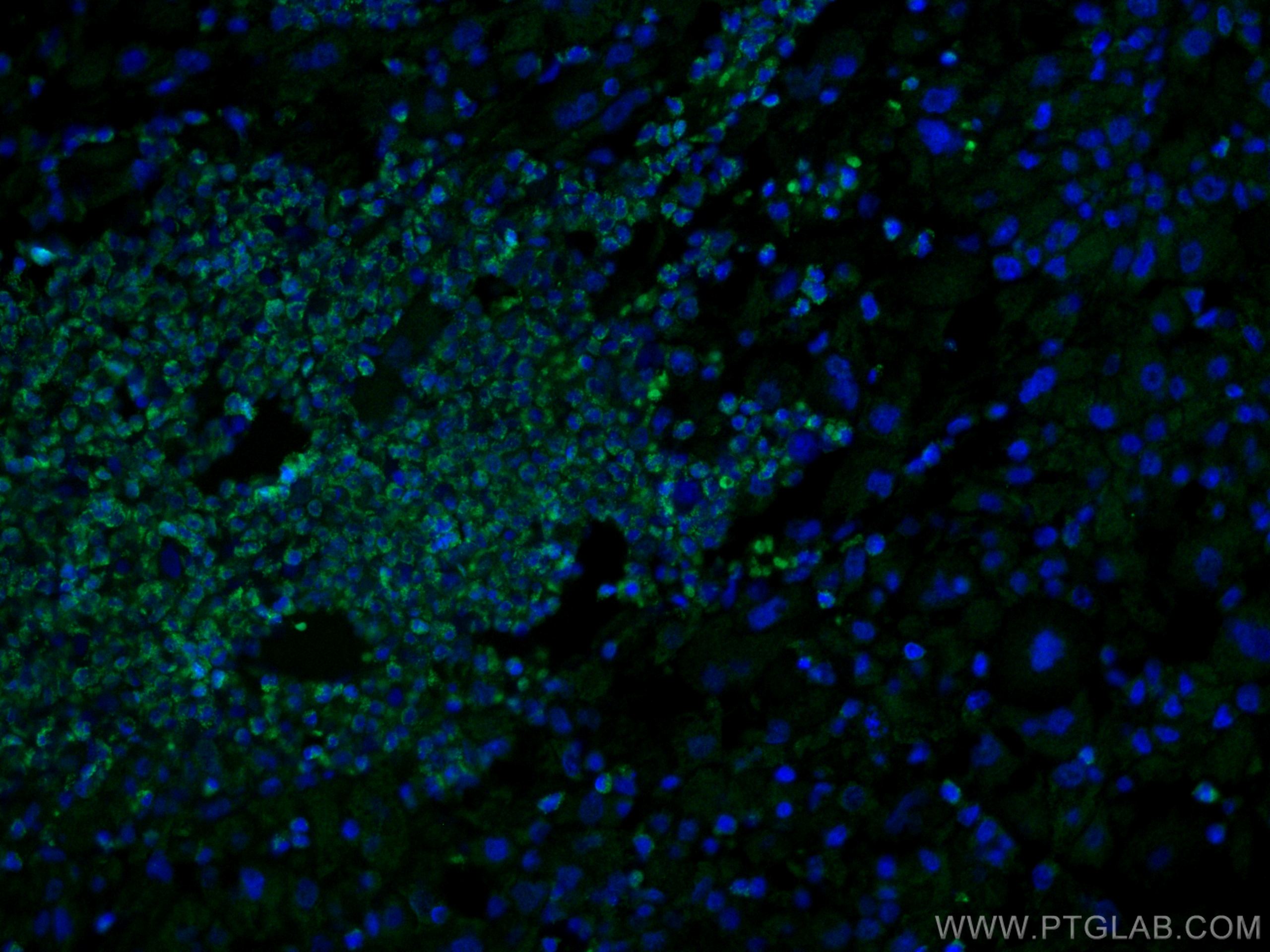 Immunofluorescence (IF) / fluorescent staining of human liver cancer tissue using CoraLite® Plus 488-conjugated MLKL Monoclonal anti (CL488-66675)