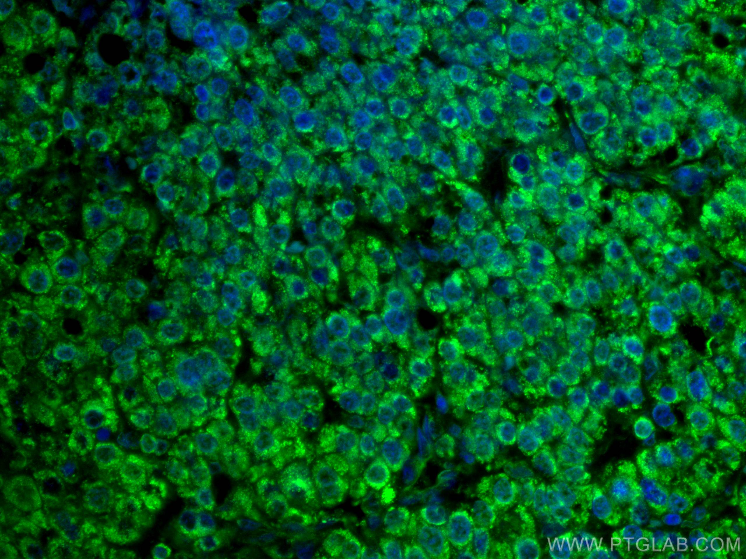 Immunofluorescence (IF) / fluorescent staining of human liver cancer tissue using CoraLite® Plus 488-conjugated MLKL Monoclonal anti (CL488-66675)