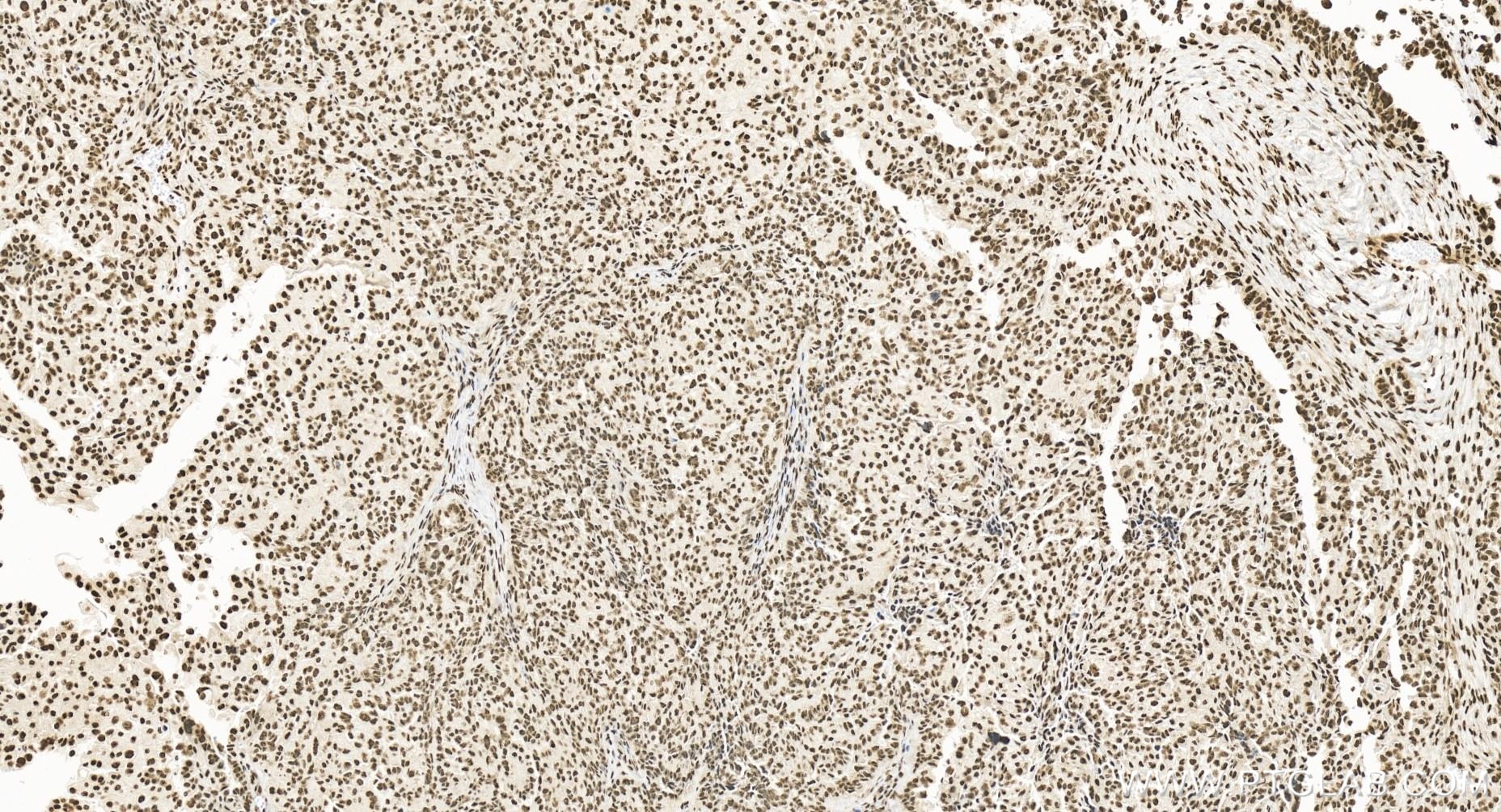 Immunohistochemistry (IHC) staining of human ovary cancer tissue using MLL4 Recombinant antibody (84410-3-RR)