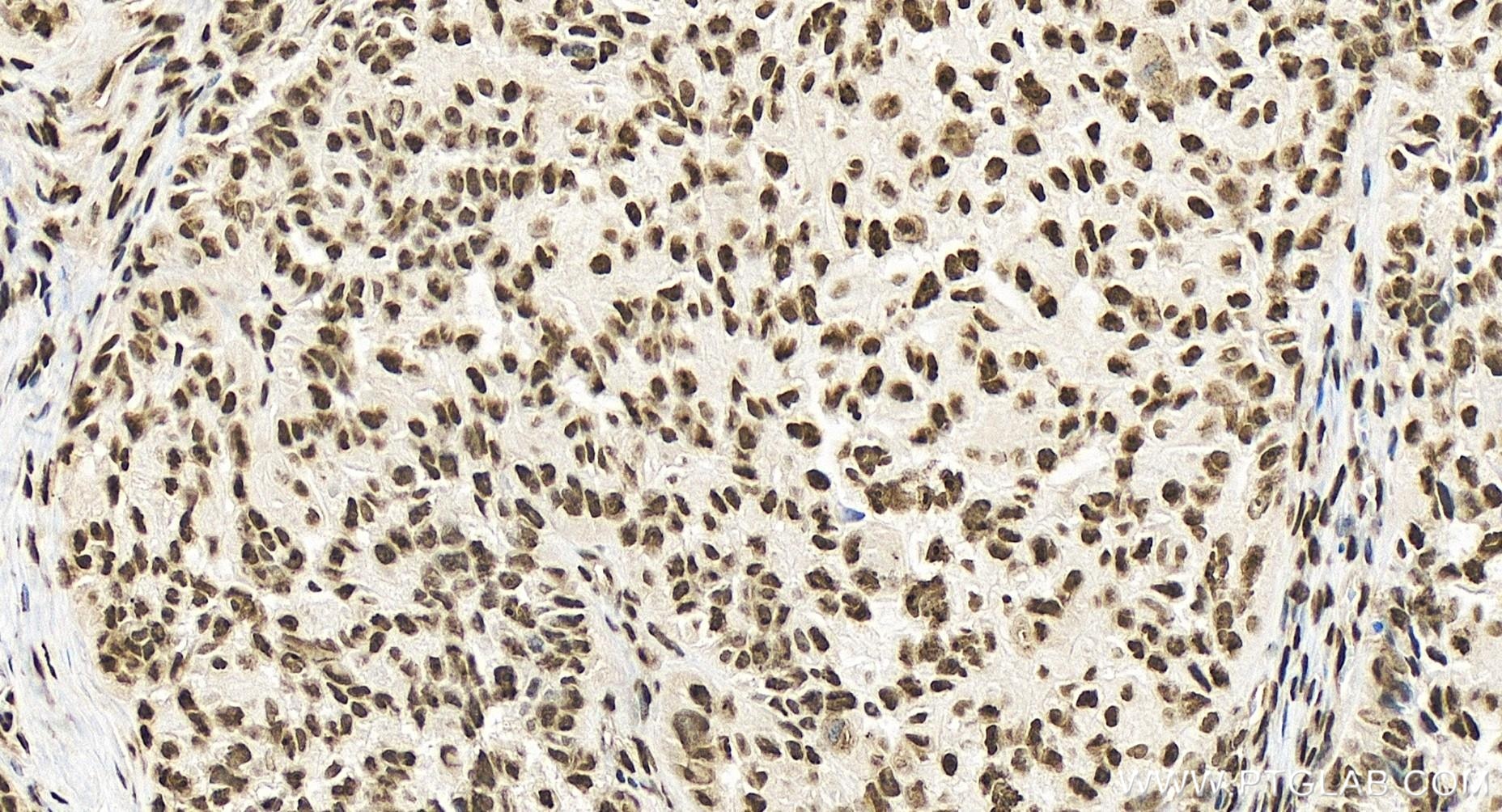 Immunohistochemistry (IHC) staining of human ovary cancer tissue using MLL4 Recombinant antibody (84410-3-RR)