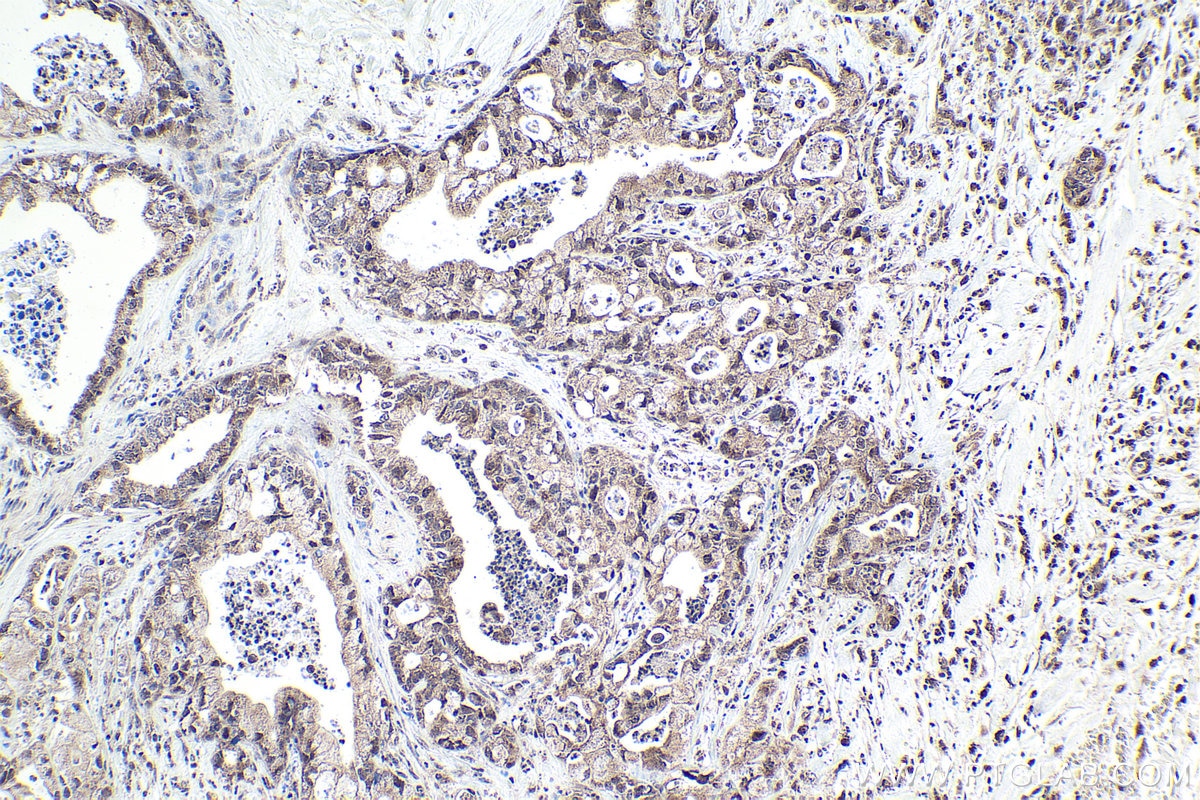 Immunohistochemistry (IHC) staining of human pancreas cancer tissue using MLL5 Polyclonal antibody (14540-1-AP)