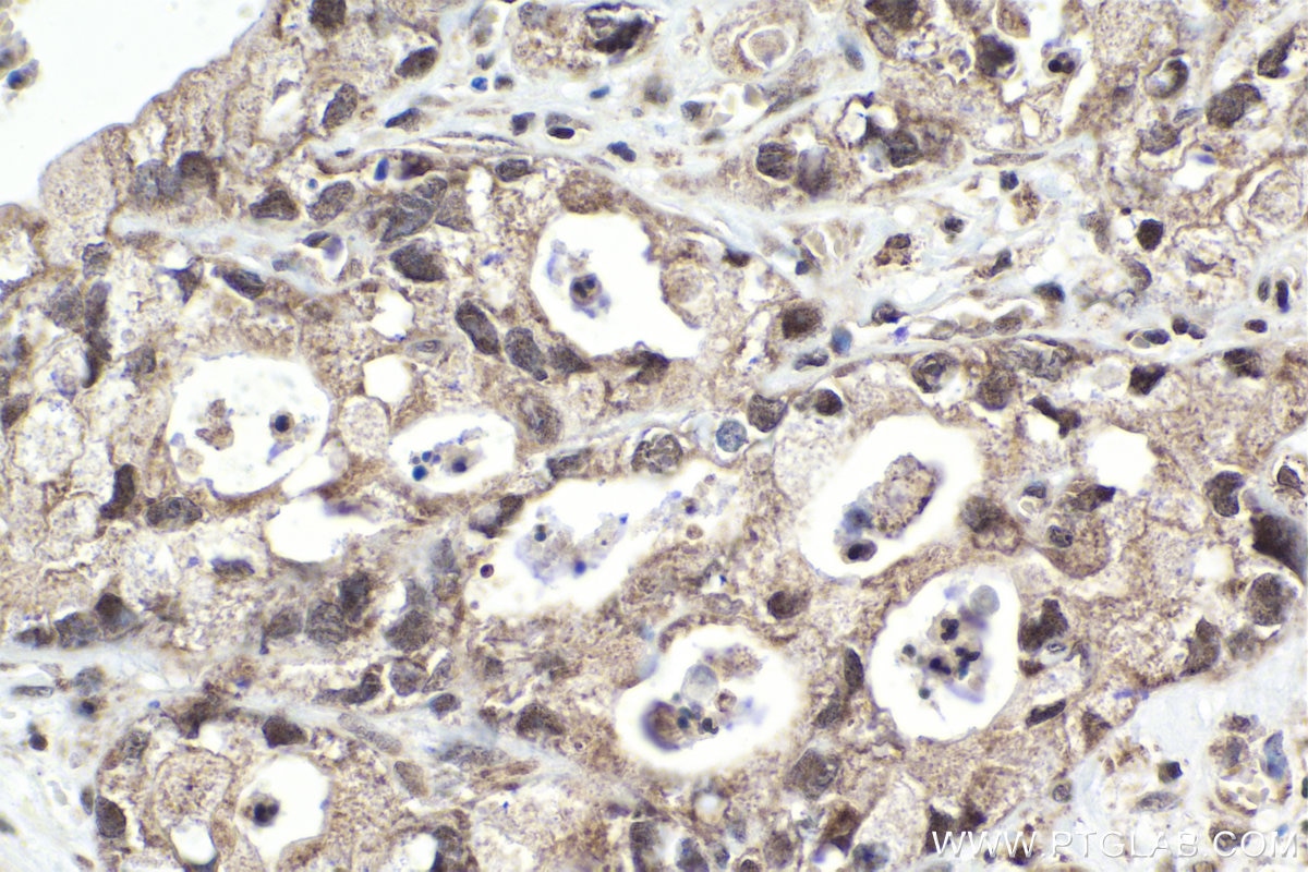 IHC staining of human pancreas cancer using 14540-1-AP