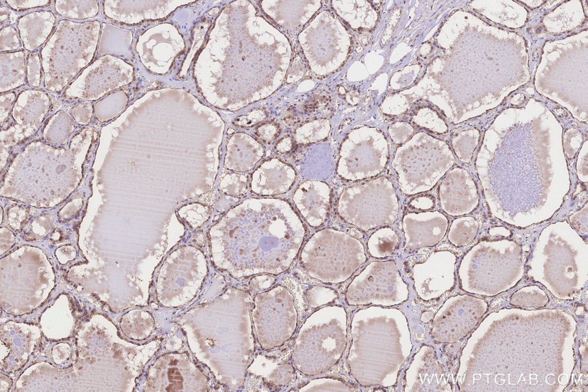 IHC staining of human thyroid cancer using 20292-1-AP Immunohistochemistry (IHC) staining of human thyroid cancer tissue using MLN64 Polyclonal antibody (20292-1-AP)