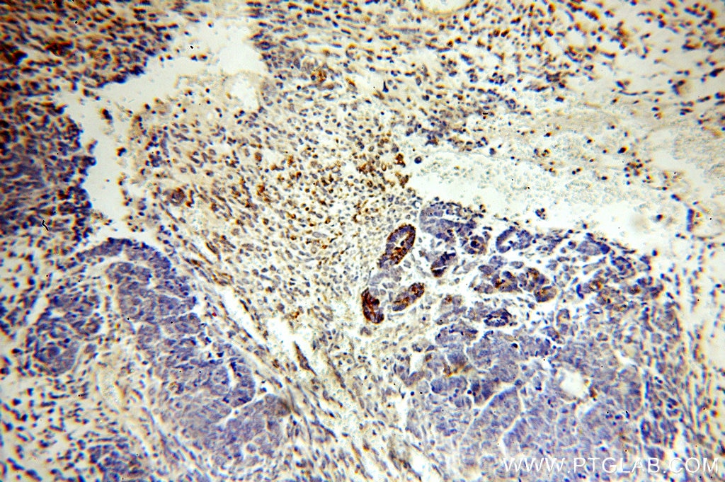 Immunohistochemistry (IHC) staining of human ovary tumor tissue using MLN64 Polyclonal antibody (20292-1-AP)