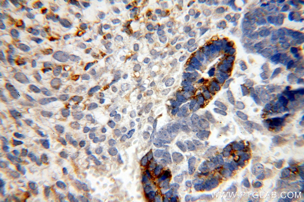 Immunohistochemistry (IHC) staining of human ovary tumor tissue using MLN64 Polyclonal antibody (20292-1-AP)