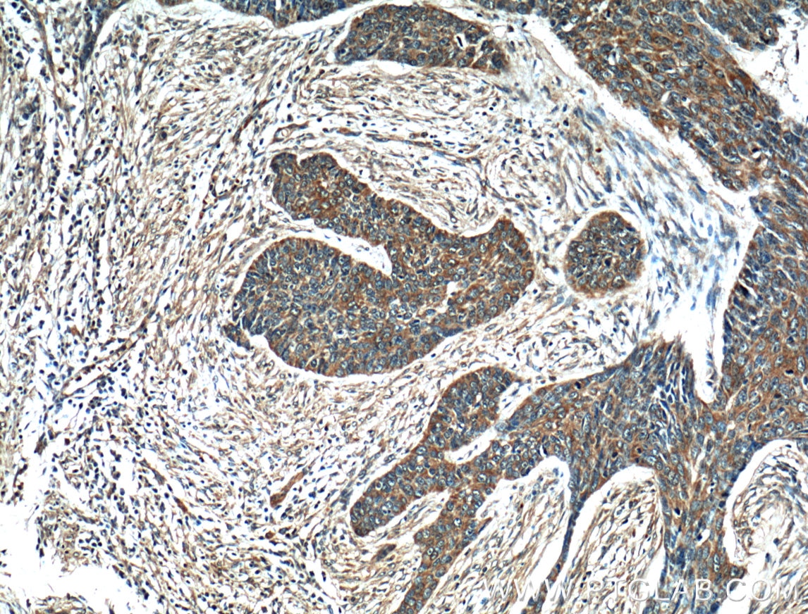 Immunohistochemistry (IHC) staining of human skin cancer tissue using Melanophilin Polyclonal antibody (10338-1-AP)