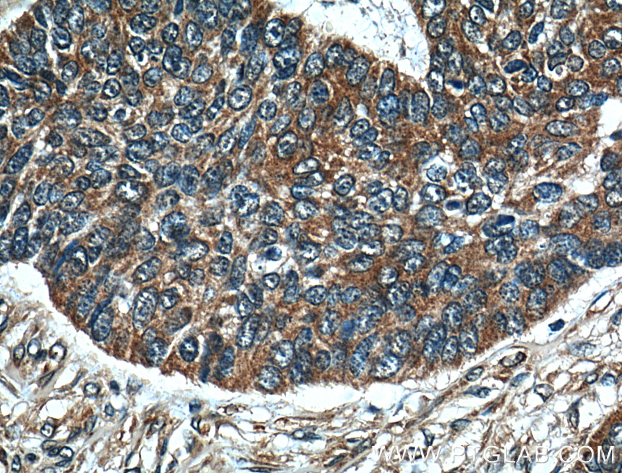 Immunohistochemistry (IHC) staining of human skin cancer tissue using Melanophilin Polyclonal antibody (10338-1-AP)