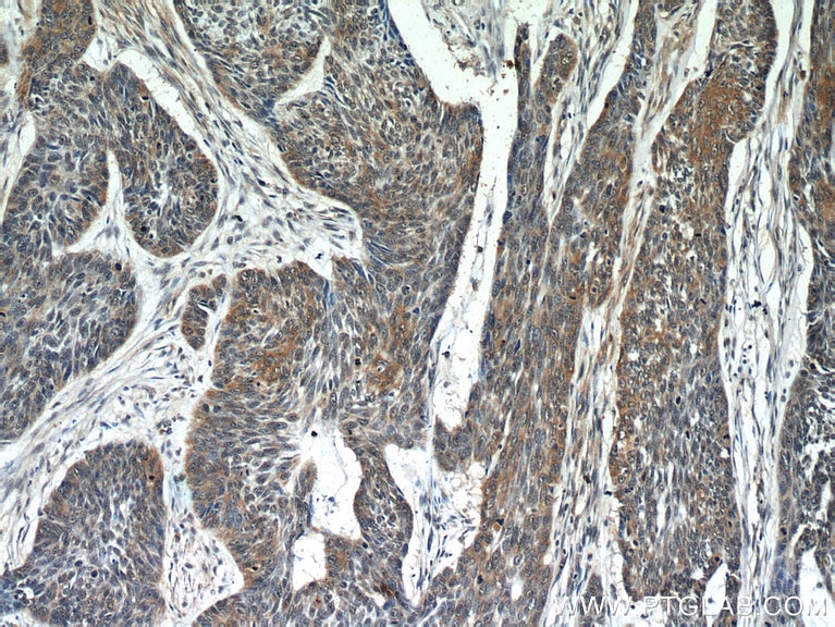 IHC staining of human skin cancer using 66092-1-Ig