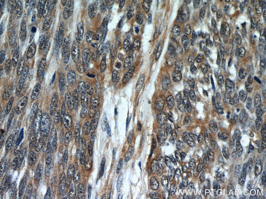 Immunohistochemistry (IHC) staining of human skin cancer tissue using Melanophilin Monoclonal antibody (66092-1-Ig)