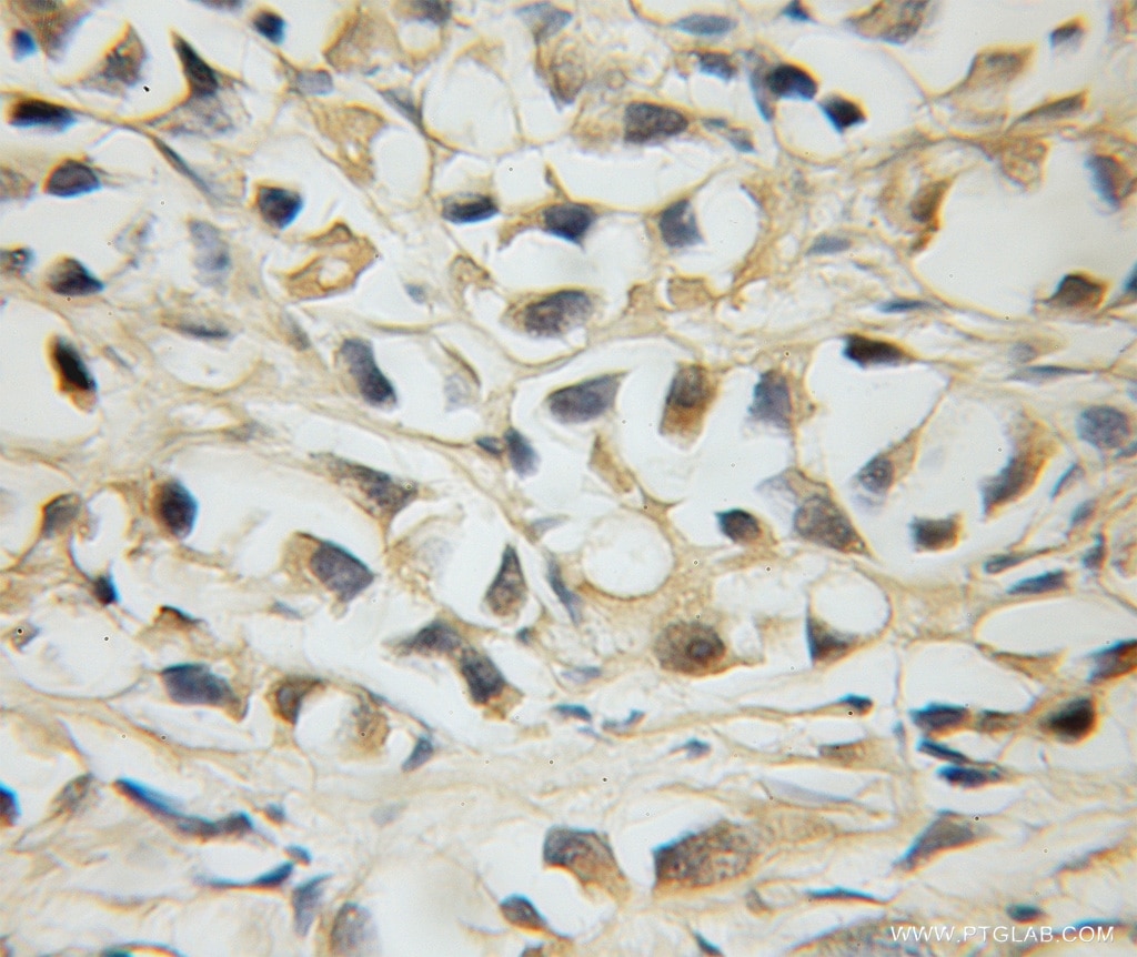 Immunohistochemistry (IHC) staining of human prostate cancer tissue using MLX Polyclonal antibody (12042-1-AP)
