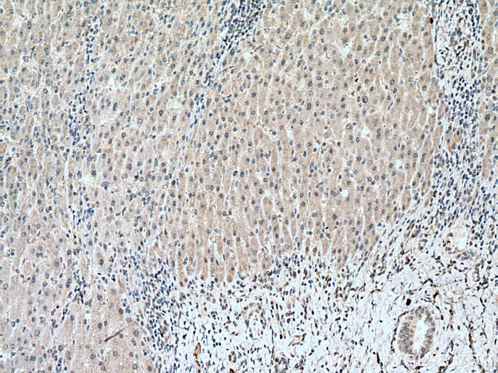 IHC staining of human liver cancer using 67042-1-Ig