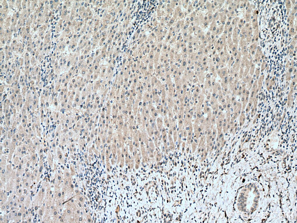 Immunohistochemistry (IHC) staining of human liver cancer tissue using MLX Monoclonal antibody (67042-1-Ig)