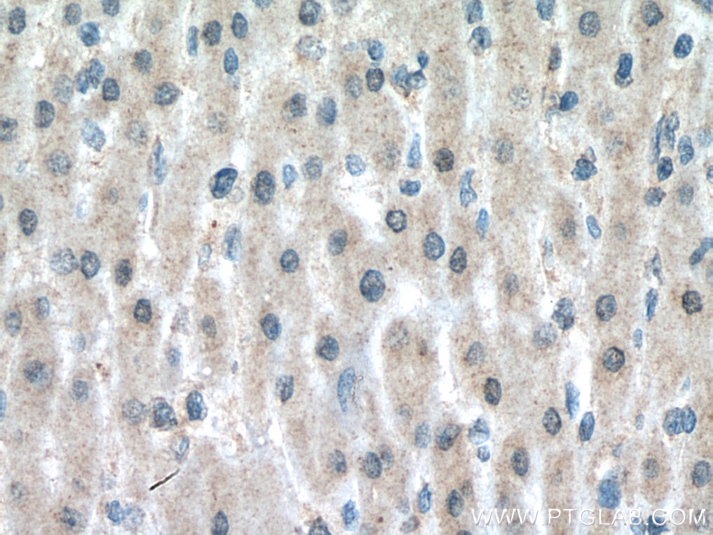 Immunohistochemistry (IHC) staining of human liver cancer tissue using MLX Monoclonal antibody (67042-1-Ig)