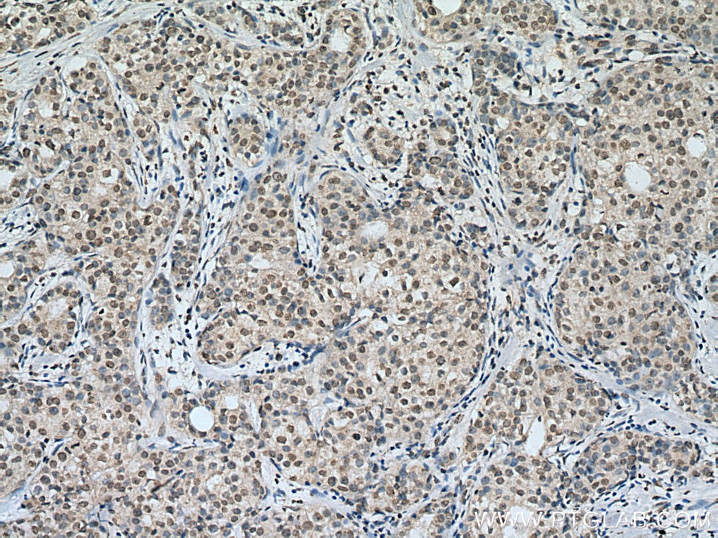 Immunohistochemistry (IHC) staining of human breast cancer tissue using MLX Monoclonal antibody (67042-1-Ig)