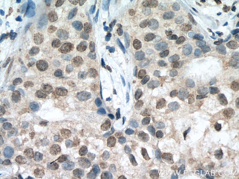IHC staining of human breast cancer using 67042-1-Ig