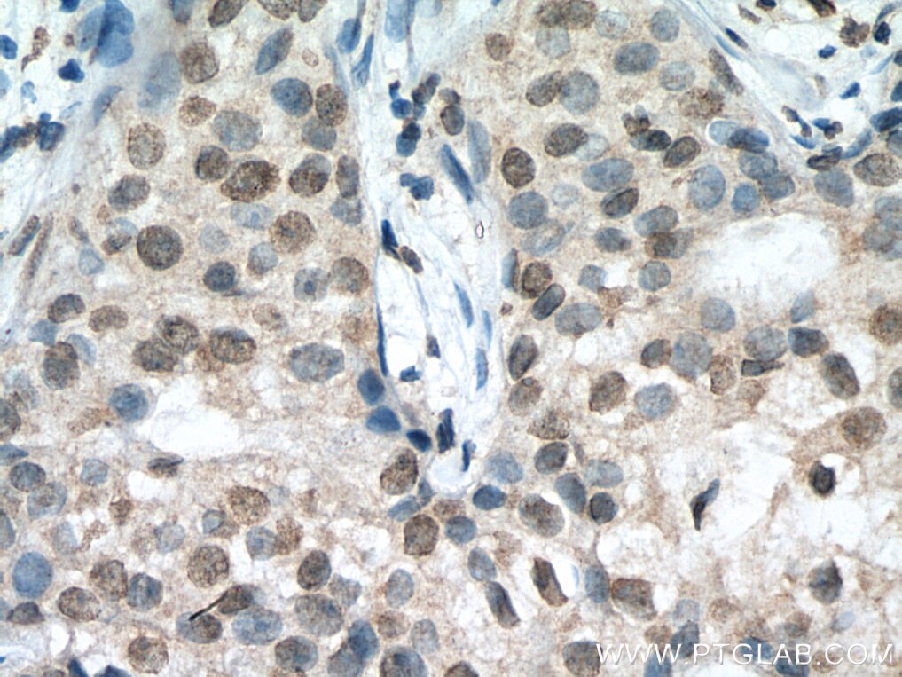 Immunohistochemistry (IHC) staining of human breast cancer tissue using MLX Monoclonal antibody (67042-1-Ig)