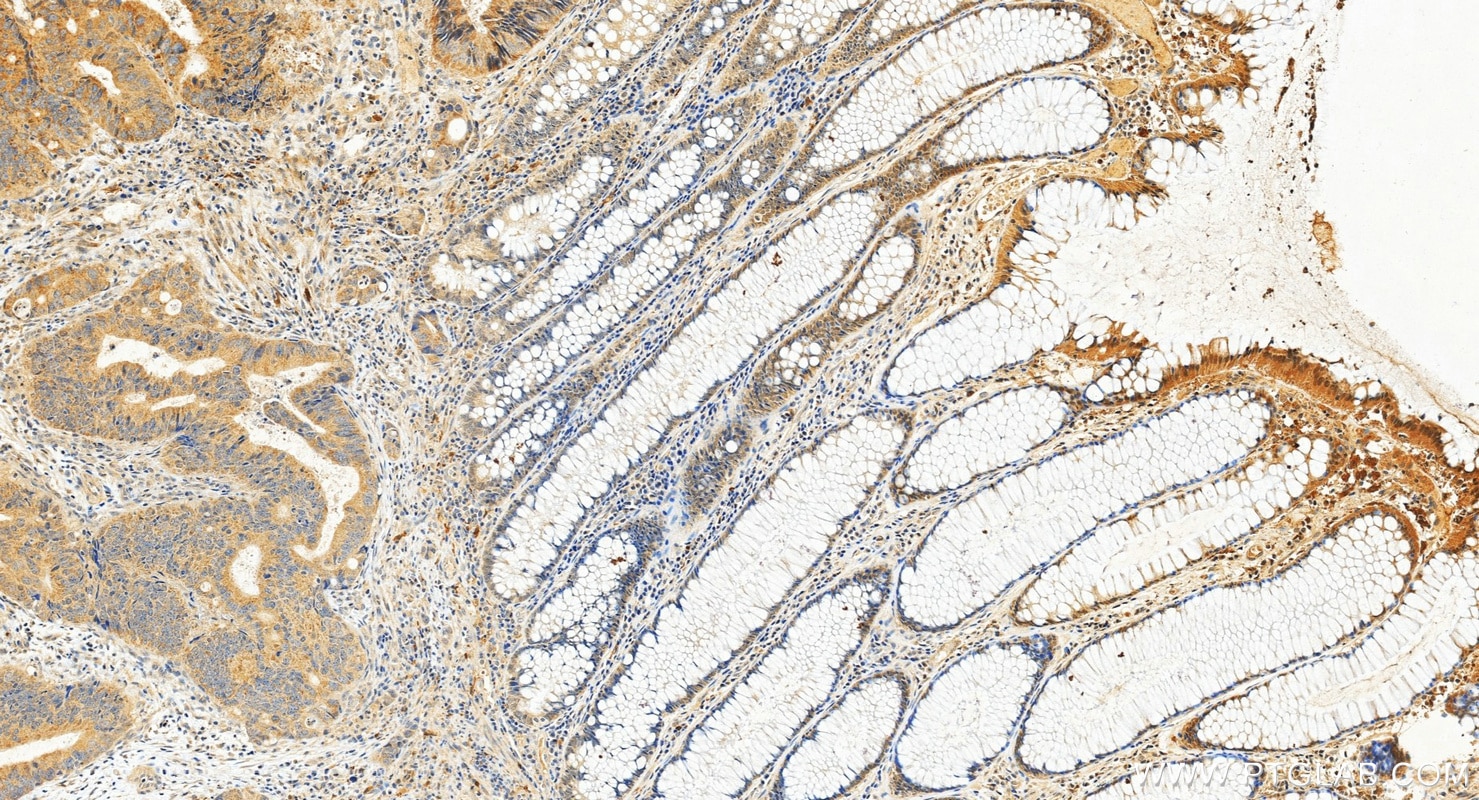 Immunohistochemistry (IHC) staining of human colon cancer tissue using MLXIPL Polyclonal antibody (13256-1-AP)