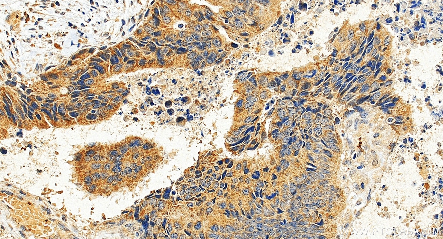 Immunohistochemistry (IHC) staining of human colon cancer tissue using MLXIPL Polyclonal antibody (13256-1-AP)
