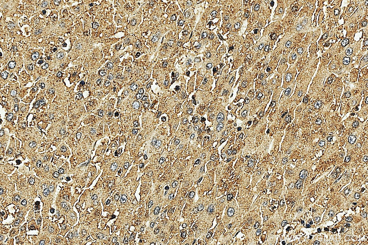 IHC staining of human liver cancer using 33703-1-AP Immunohistochemistry (IHC) staining of human liver cancer tissue using MLXIPL Polyclonal antibody (33703-1-AP)