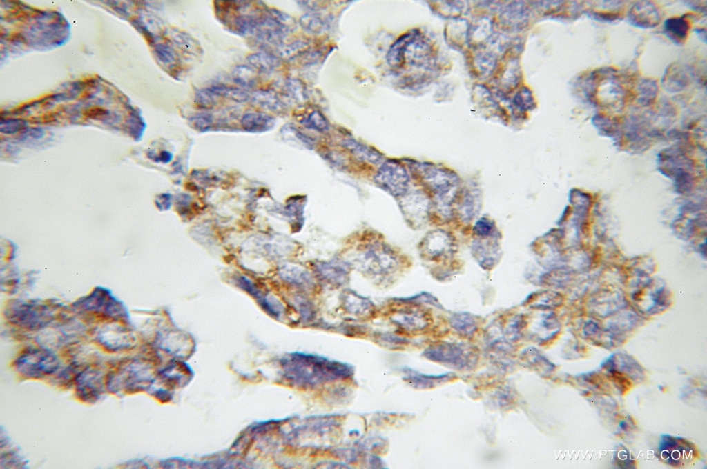 Immunohistochemistry (IHC) staining of human ovary tumor tissue using MMAB Polyclonal antibody (11137-1-AP)