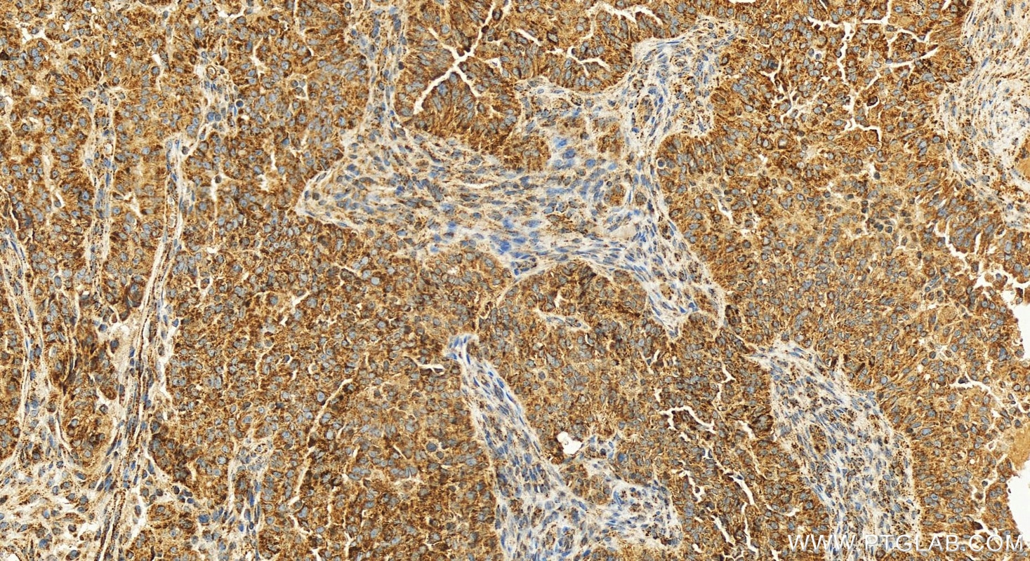 Immunohistochemical analysis of paraffin-embedded human ovarian cancer slide using 11137-1-AP (MMAB antibody) at dilution of 1:200 (under 20x lens). Heat mediated antigen retrieval with Tris-EDTA buffer (pH 9.0). Immunohistochemistry (IHC) staining of human ovarian cancer using MMAB Polyclonal antibody (11137-1-AP)