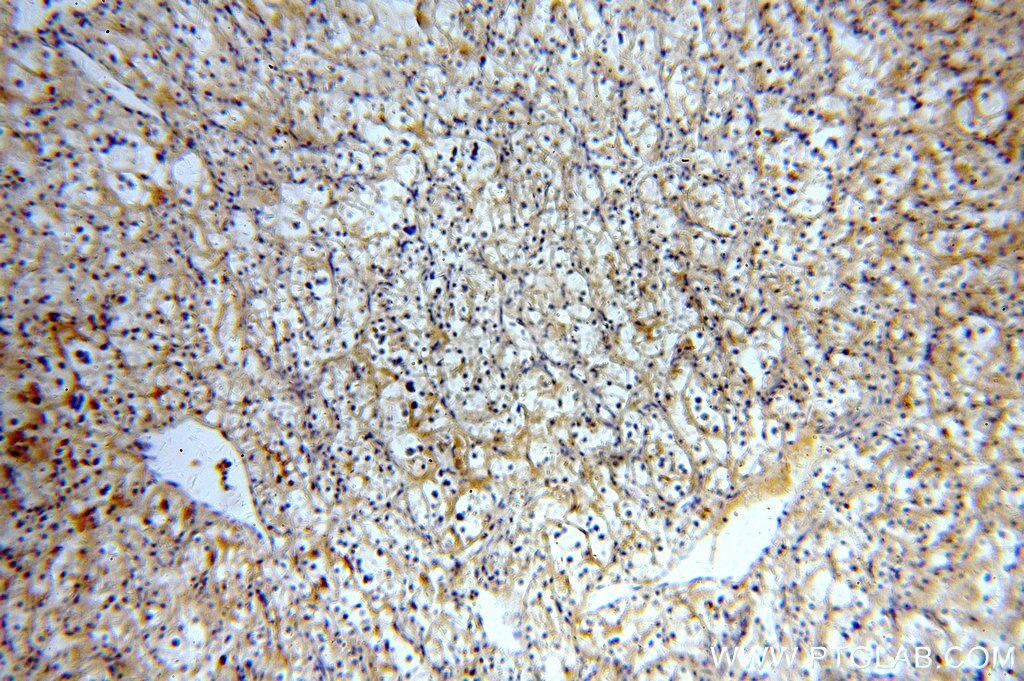 IHC staining of human renal cell carcinoma using 10302-1-AP