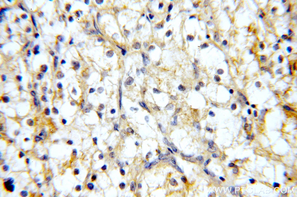 Immunohistochemistry (IHC) staining of human renal cell carcinoma tissue using MME,CD10 Polyclonal antibody (10302-1-AP)