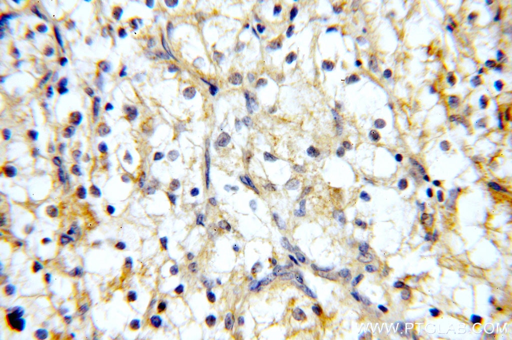 IHC staining of human renal cell carcinoma using 10302-1-AP