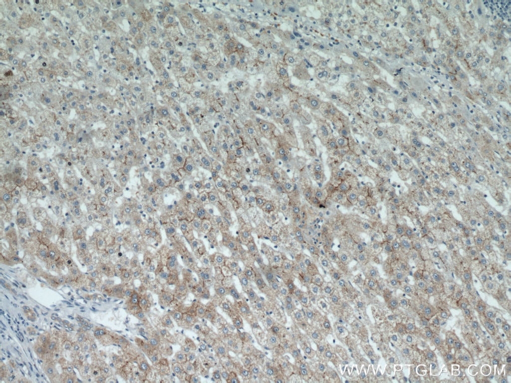 Immunohistochemistry (IHC) staining of human liver cancer tissue using MME,CD10 Polyclonal antibody (10302-1-AP)