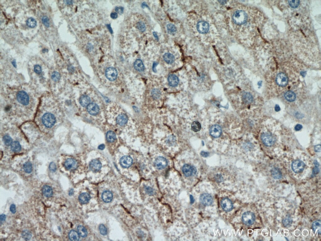 Immunohistochemistry (IHC) staining of human liver cancer tissue using MME,CD10 Polyclonal antibody (10302-1-AP)