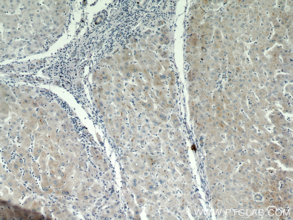 IHC staining of human hepatocirrhosis using 10302-1-AP