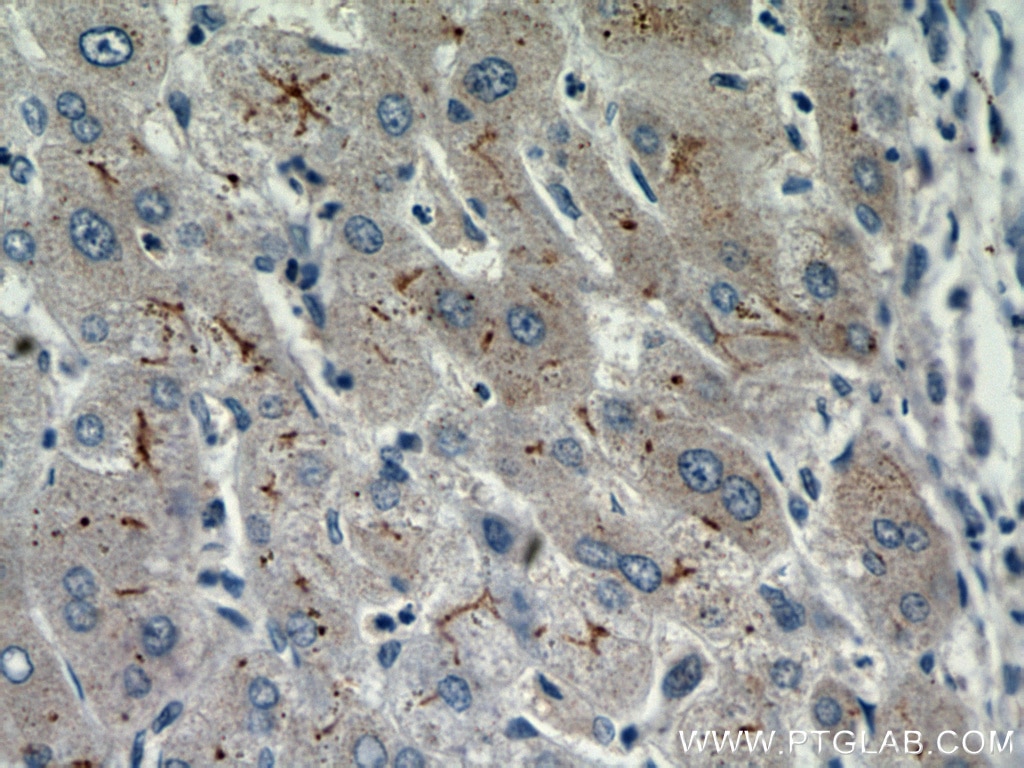 Immunohistochemistry (IHC) staining of human hepatocirrhosis tissue using MME,CD10 Polyclonal antibody (10302-1-AP)