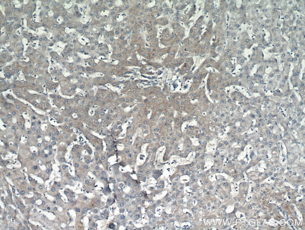 Immunohistochemistry (IHC) staining of human hepatocirrhosis tissue using MME,CD10 Polyclonal antibody (10302-1-AP)