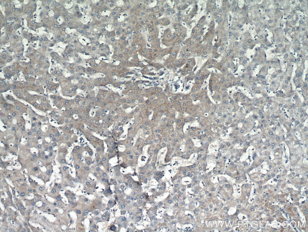 IHC staining of human hepatocirrhosis using 10302-1-AP