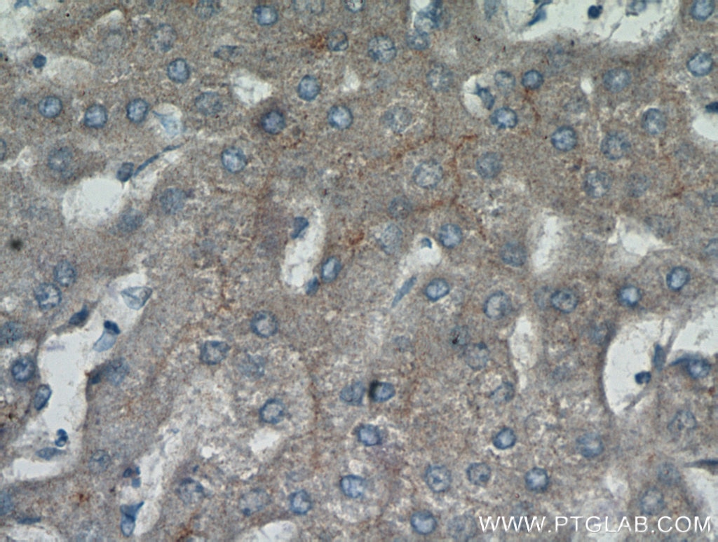 IHC staining of human hepatocirrhosis using 10302-1-AP