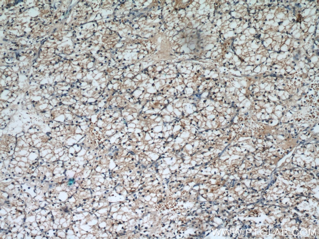 Immunohistochemistry (IHC) staining of human renal cell carcinoma tissue using MME,CD10 Polyclonal antibody (10302-1-AP)