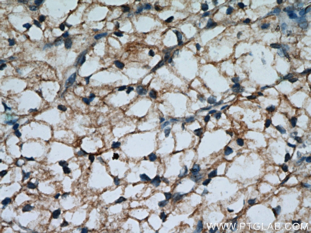 IHC staining of human renal cell carcinoma using 10302-1-AP